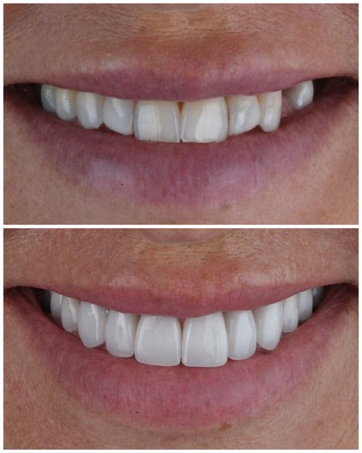 How Much Are Veneers Per Tooth 